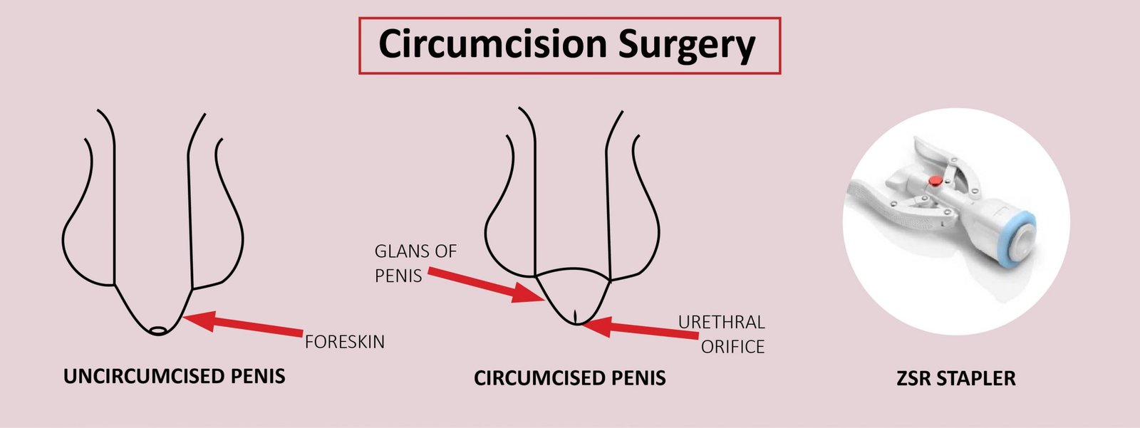Foreskin Removal Male Circumcision Health Benefits And Safety Foreskin Removal Male Circumcision Health Benefits And Safety