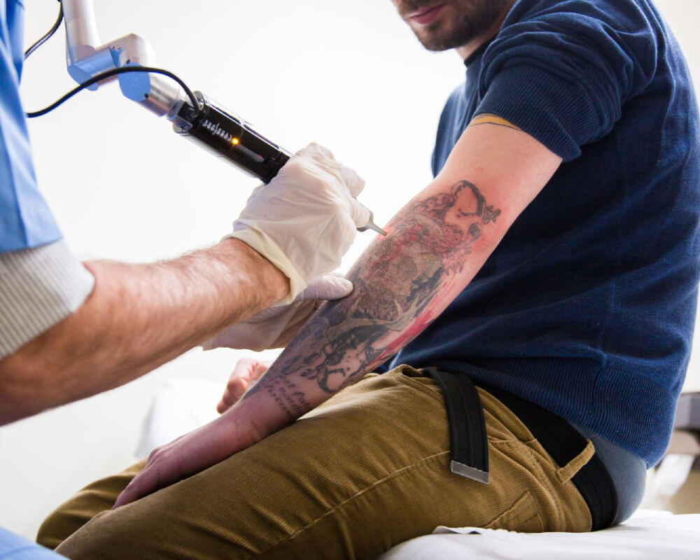 Laser Tattoo Removal Tupelo  North MS  Accent Plastic Surgery