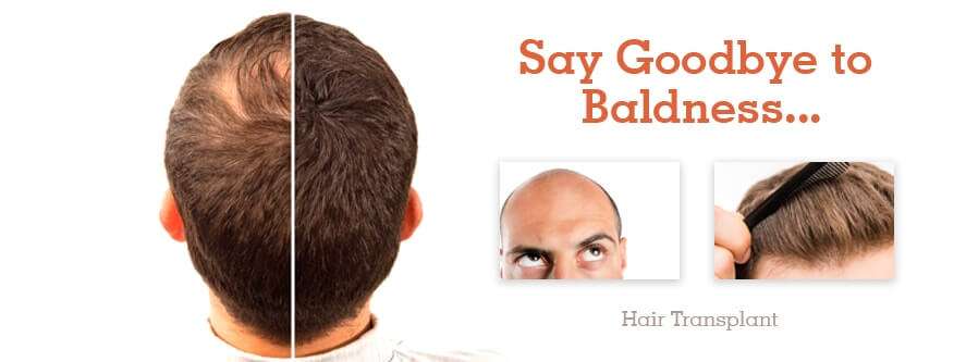 Fue hair transplant